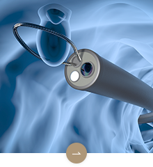 大腸ポリープ切除