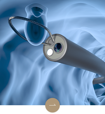 大腸ポリープ切除